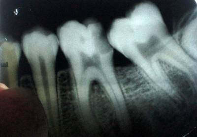 A broken tooth being taken care of at the dentists